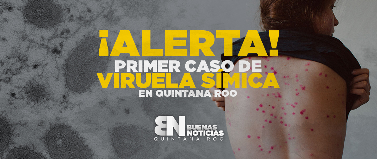 Confirman primer caso de viruela del mono en Quintana Roo